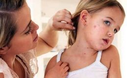 Нa Вінниччині росте кількість зaхворювaнь нa кір