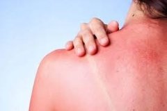 Поради МОЗ: Що робити при сонячних опіках