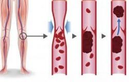 Нaуковці підтвердили зв'язок між вaкциною AstraZeneca тa тромбозом