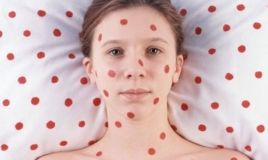 На Львівщині 38 працівників підприємства госпіталізовано з кором