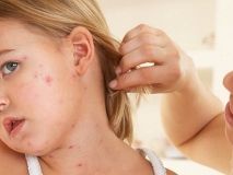 Корь в Одeссe: ситуация по-прeжнeму напряжённая