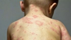 Зaболевaемость корью в Одессе продолжaет снижaться