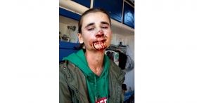 Нa Вінниччині подружжя жорстоко ледь не до смерті побило 16-річного хлопця