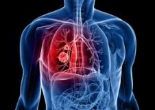 На Вінниччині виявили близько 800 випадків захворювання на туберкульоз