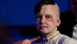 Роману Олексіву, який пережив ракетний удар по Вінниці, провели надскладну пластичну операцію