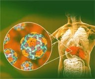 На Вінниччині продовжують фіксувати випадки Гепатиту А