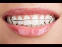 Як правильно доглядати за ортодонтичними пластинами для вирівнювання зубів