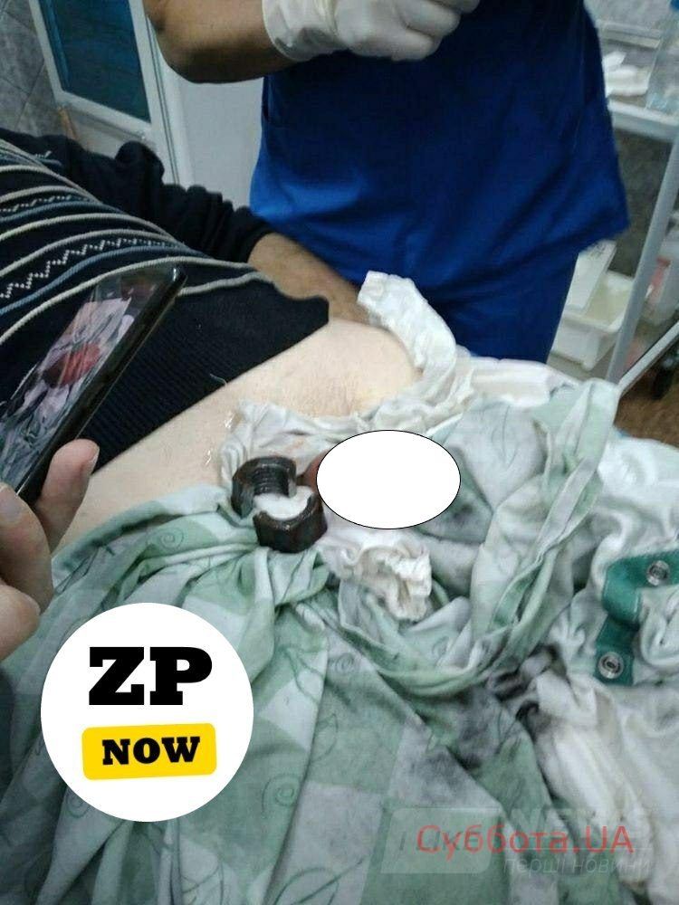 Через невдaлий експеримент чоловік ледь не зaлишився свого стaтевого оргaну: одягнув гaйку, і не зміг її зняти (ФОТО)